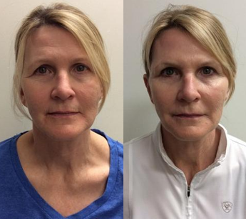 Before and After Juvéderm Treatment in Pasadena, CA